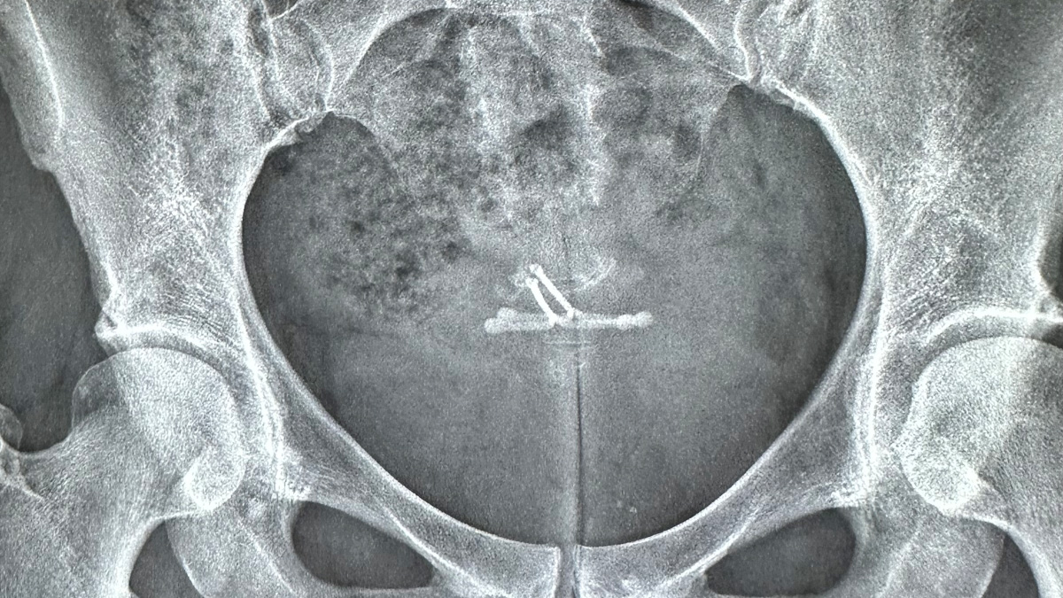 Teaserbild zum CME: Intrauterine Verhütung in der Praxis: Aktuelle Empfehlungen mit Aha-Effekt! Teaserbild zum CME: Intrauterine Verhütung in der Praxis: Aktuelle Empfehlungen mit Aha-Effekt!