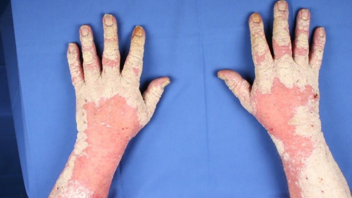 Logo der CME Fortbildung "Behandlung von Psoriasis-Patienten - Bedeutung von Real World Daten"