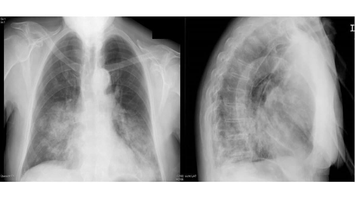 Logo der CME Fortbildung "Management ambulant erworbener Pneumonien"