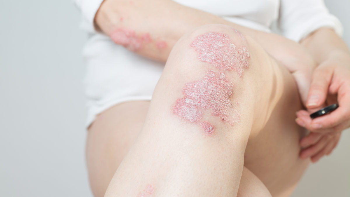 Logo der CME Fortbildung "Interleukin-17-Isoformen in der Immunpathogenese der Psoriasis. Wo liegt der Unterschied?"