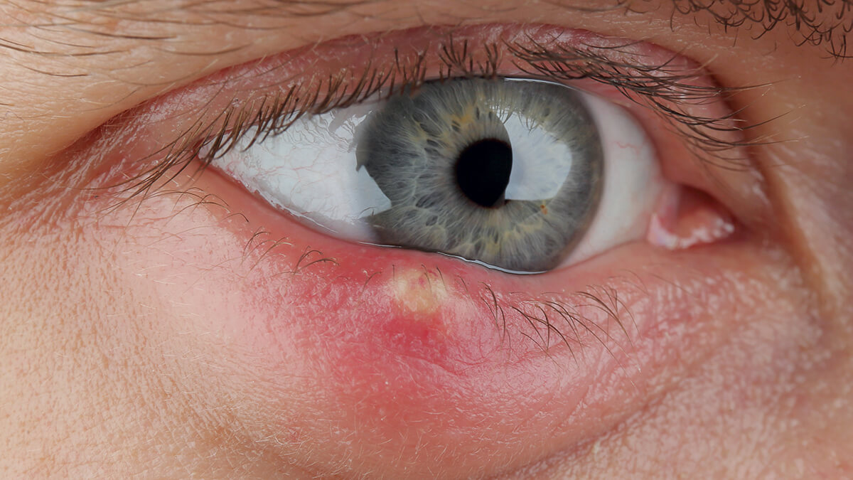 Logo der CME Fortbildung "Entzündungen am Auge - Von Blepharitis bis zum trockenen Auge"