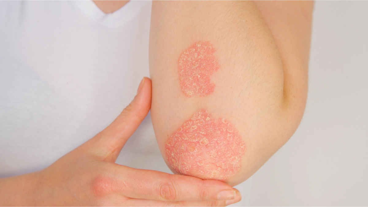 Logo der CME Fortbildung "Psoriasis und Lebensqualität - Wie beeinflusst Psoriasis das Wohlbefinden und wie kann man dieses verbessern?"