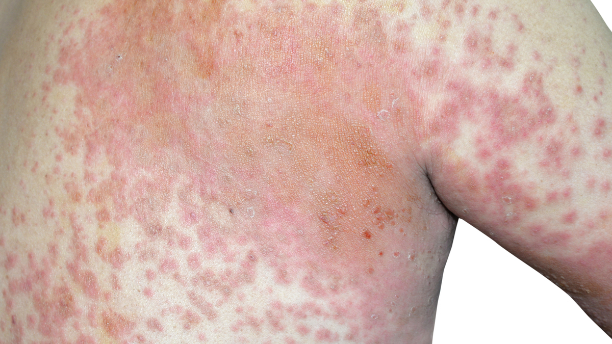 Logo der CME Fortbildung "Atopische Dermatitis - Können wir das Feuer bald löschen?"