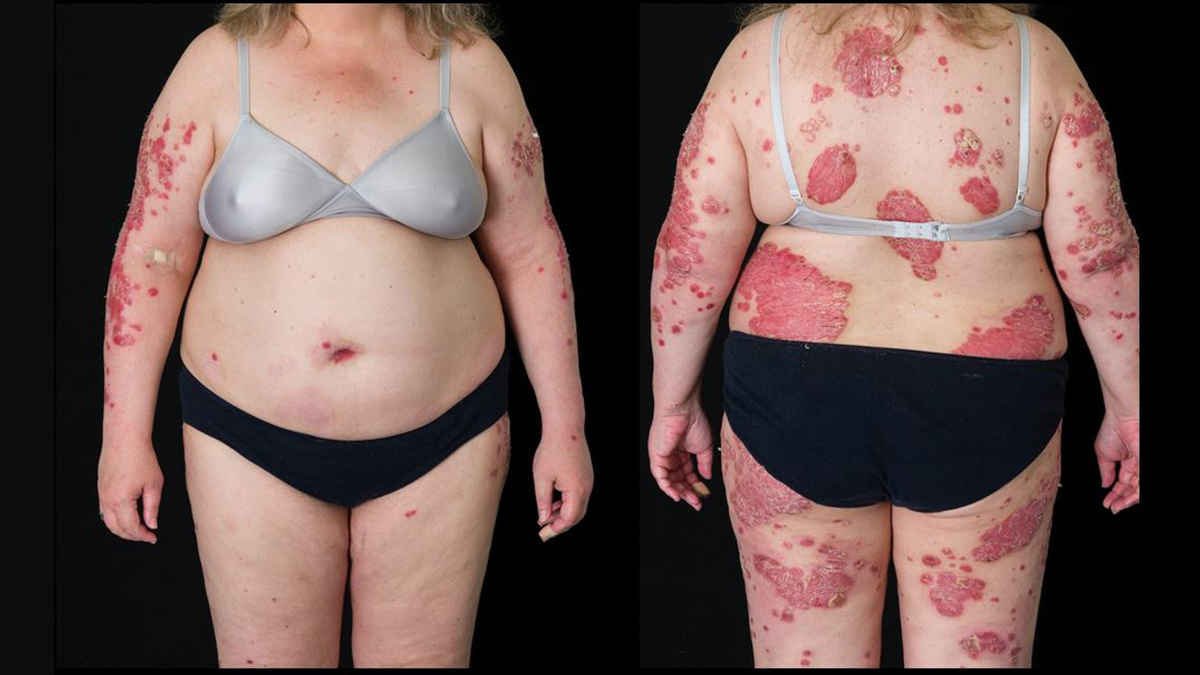 Logo der CME Fortbildung "Psoriasis und das Metabolische Syndrom"