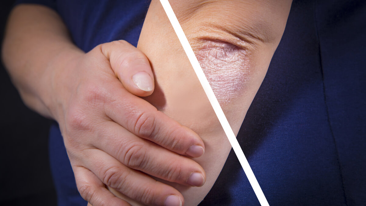 Logo der CME Fortbildung "Perspektiven der topischen Therapie in der Psoriasis"