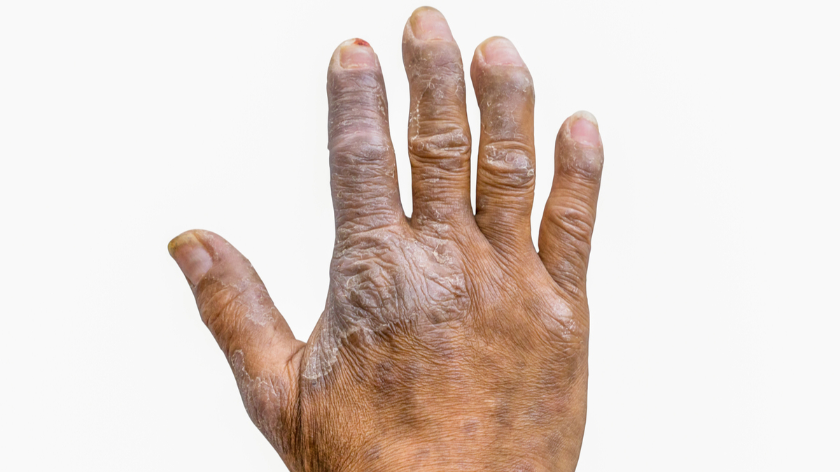 Logo der CME Fortbildung "Psoriaris-Arthritis: Aktuelle Empfehlungen und Therapiemöglichkeiten"