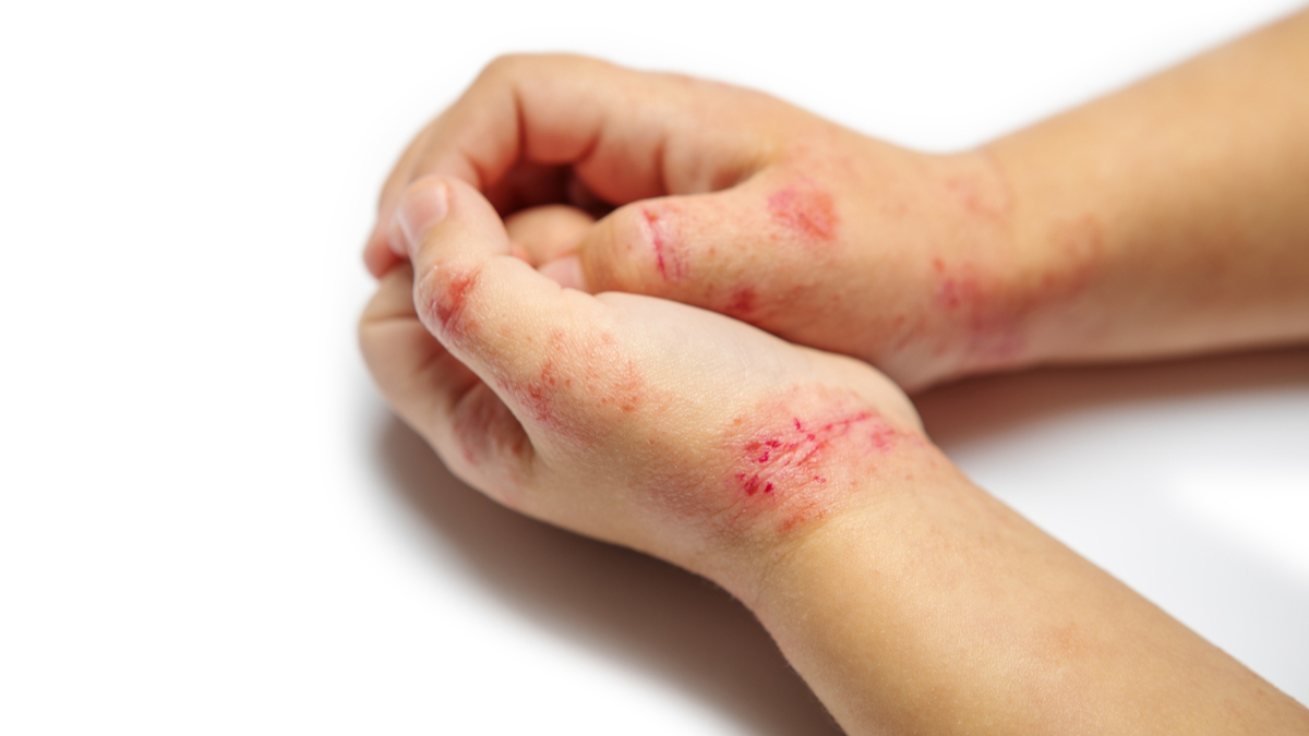 Logo der CME Fortbildung "AAD Update Atopische Dermatitis - Was gibt es Neues?"