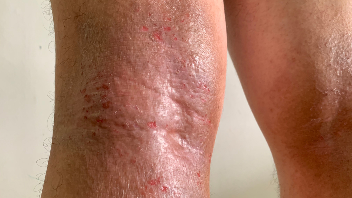 Logo der CME Fortbildung "Leitlinienupdate Atopische Dermatitis"