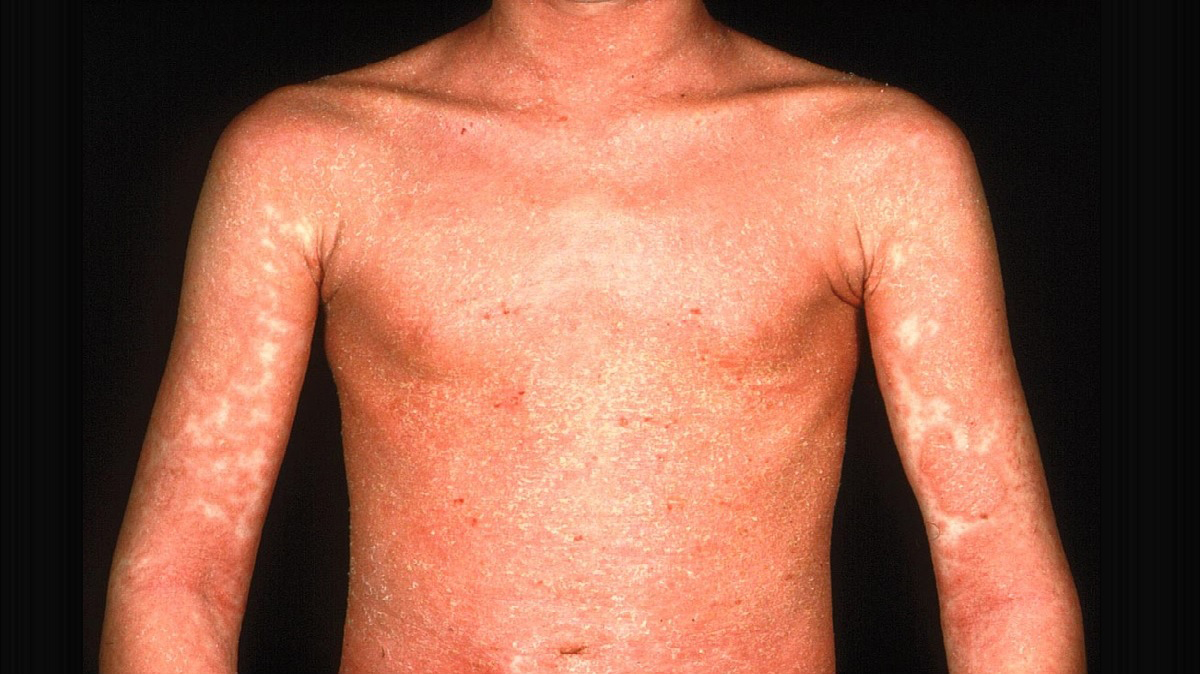 Logo der CME Fortbildung "Psoriasis bei Kindern und Jugendlichen – Formen und Therapieoptionen"