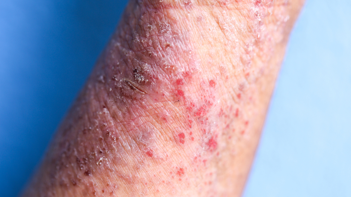Logo der CME Fortbildung "Update Atopische Dermatitis - A revolution in the making"