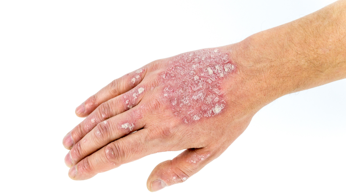 Logo der CME Fortbildung "Erstbiologikatherapie bei Patienten mit Psoriasis"
