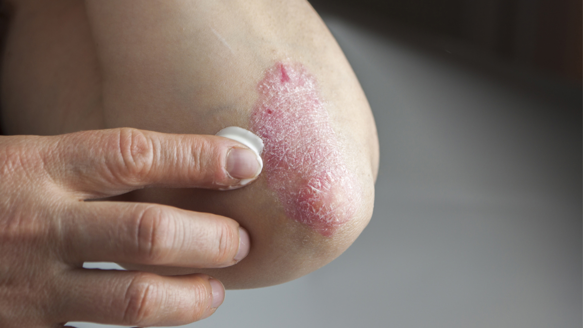 Logo der CME Fortbildung "Welchen Unterschied macht die Galenik? Am Beispiel der topischen Behandlung der Psoriasis"