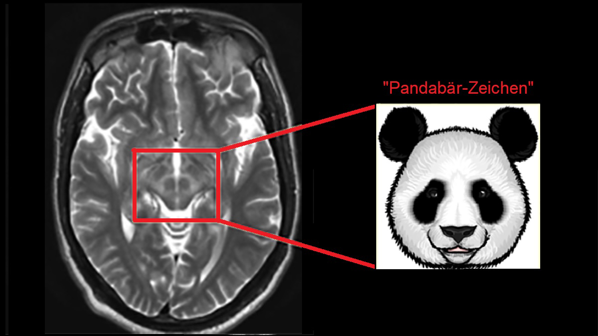 Logo der CME Fortbildung "Morbus Wilson - das Chamäleon erkennen – die Perspektive des Neurologen"