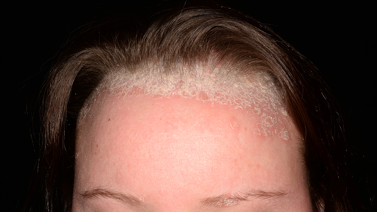 Logo der CME Fortbildung "Psoriasis - Was gilt es bei der Therapie von hard-to-treat Arealen zu beachten?"