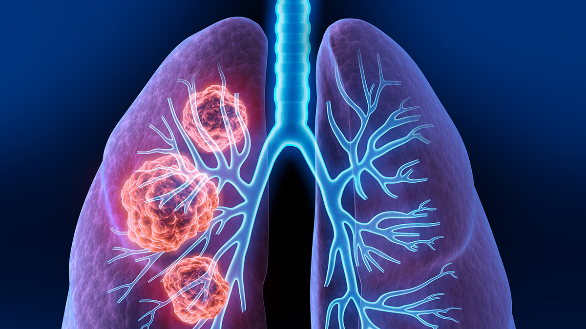 Logo der CME Fortbildung "Das ALK-positive nicht-kleinzellige Lungenkarzinom (ALK+ NSCLC) und seine Therapie im fortgeschrittenen Stadium -UPDATE-"