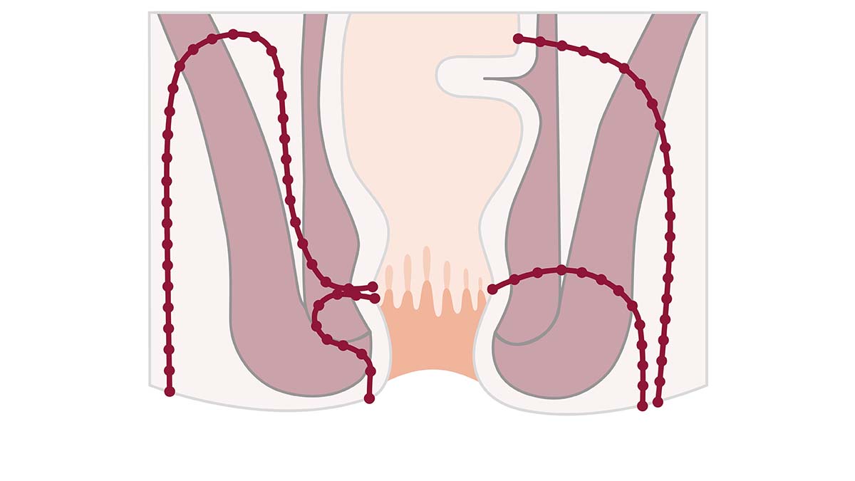 Logo der CME Fortbildung "Interdisziplinäre Therapie perianaler Fisteln bei Morbus Crohn"