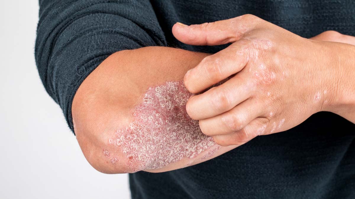 Logo der CME Fortbildung "Das WWW der Psoriasis-Therapie: Wann, Was und Warum?"