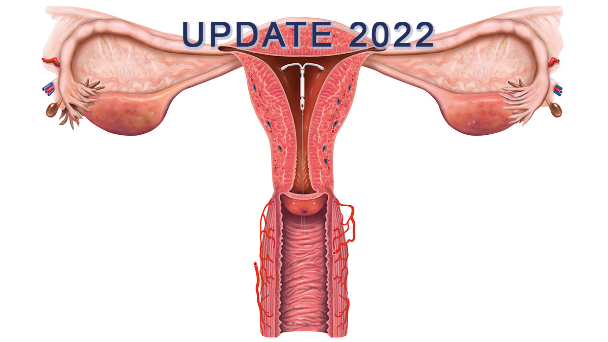 Logo der CME Fortbildung "Aktualisierte Konsensusempfehlungen zur Anwendung
von Levonorgestrel-haltigen Intrauterinsystemen"