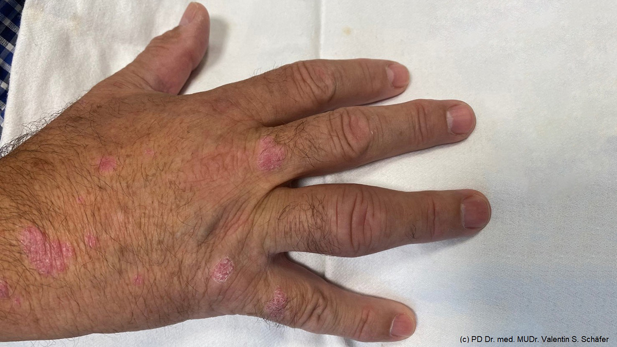 Logo der CME Fortbildung "Umfassende Behandlung von Psoriasis und Psoriasis-Arthritis"