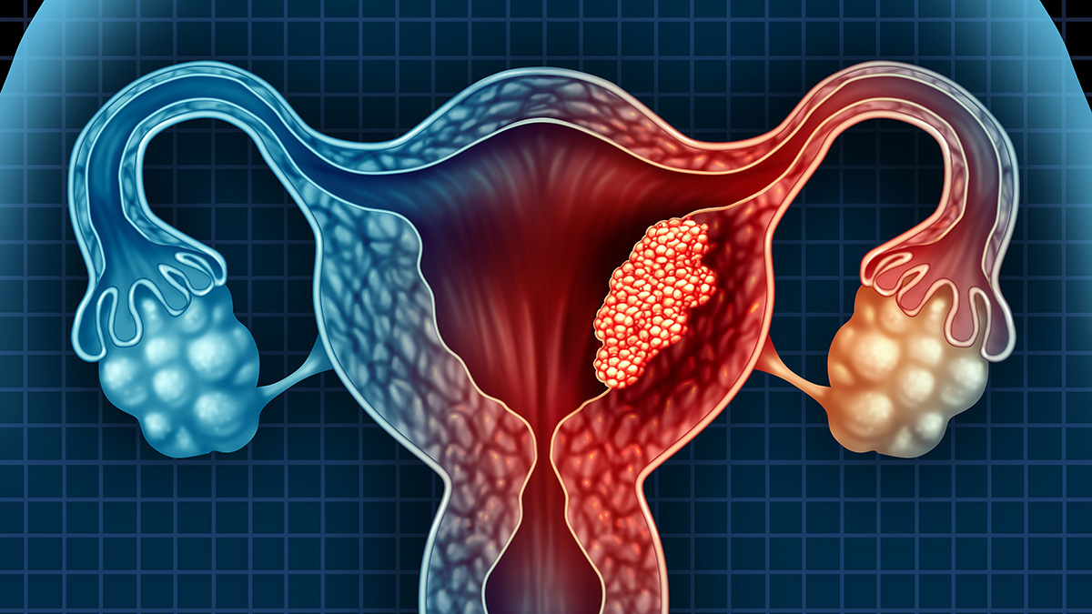 Logo der CME Fortbildung "Fortgeschrittenes und rezidiviertes Endometriumkarzinom  – aktuelle Therapien"