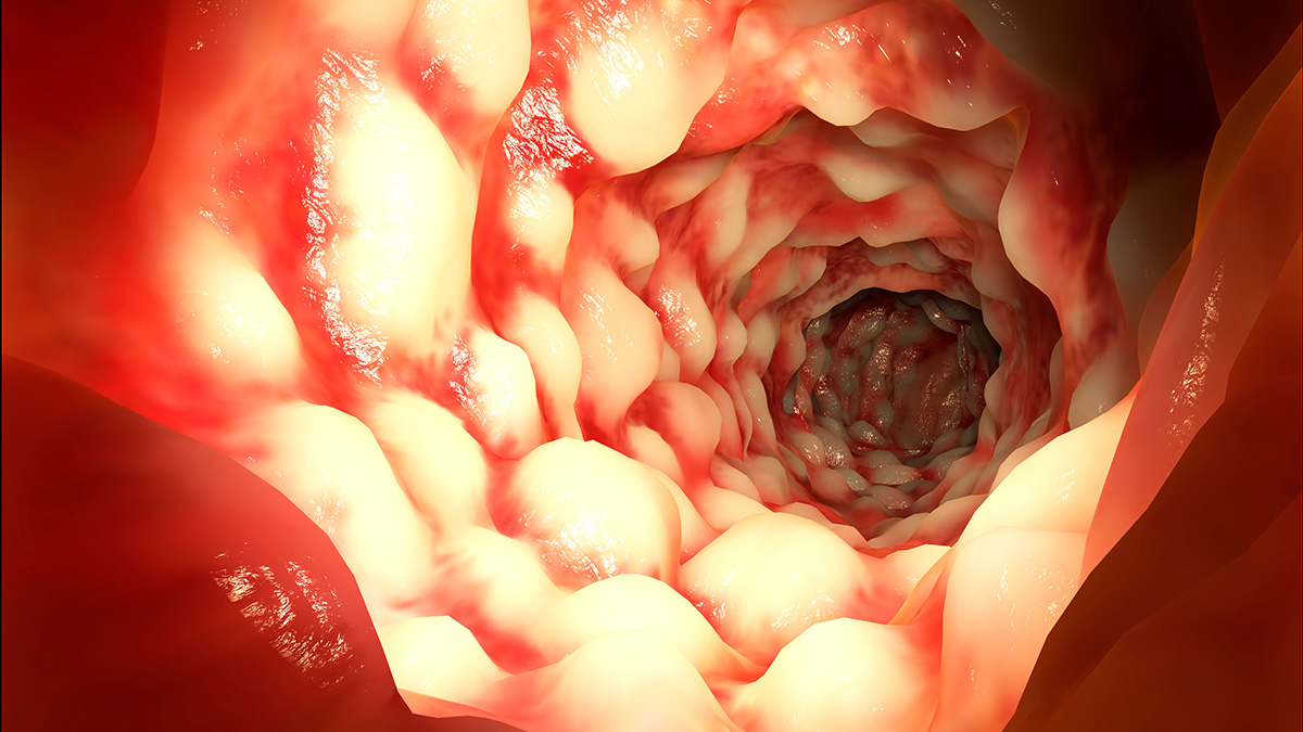 Teaserbild zum CME: "Disease Modification" als erreichbares Ziel bei Patienten mit Morbus Crohn?