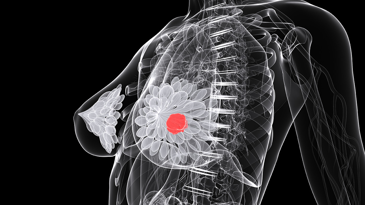 Logo der CME Fortbildung "Der Brustkrebs-Podcast: Evidenz-basierte Medizin vs. Reale Welt mit Beispielen"