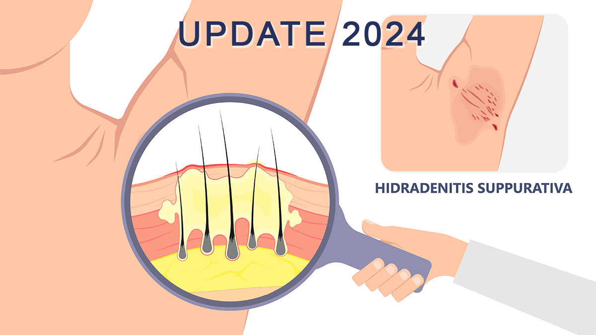 Teaserbild zum CME: Hidradenitis suppurativa / Akne inversa verstehen, erkennen und behandeln