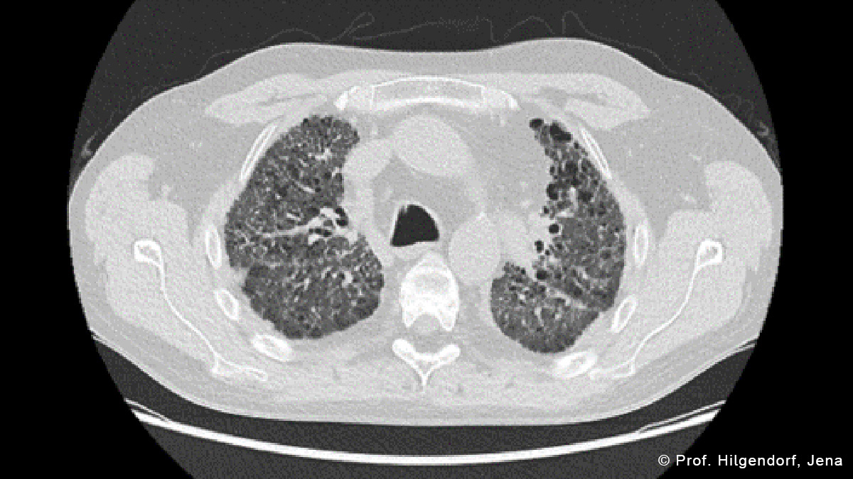 Teaserbild zum CME: Chronische Graft-versus-Host-Erkrankung (cGvHD) - Atypische Manifestationen und therapeutische Herausforderungen