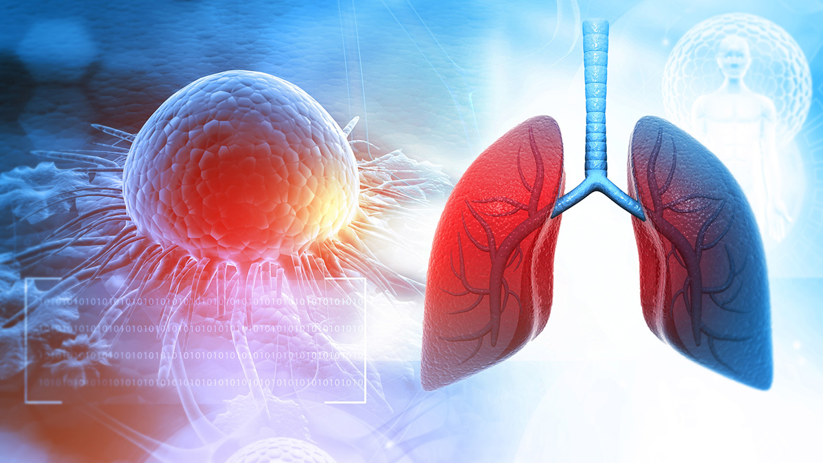 Teaserbild zum CME: Erstlinientherapie bei ALK-positivem NSCLC: Überblick und Umgang mit therapeutischen Optionen