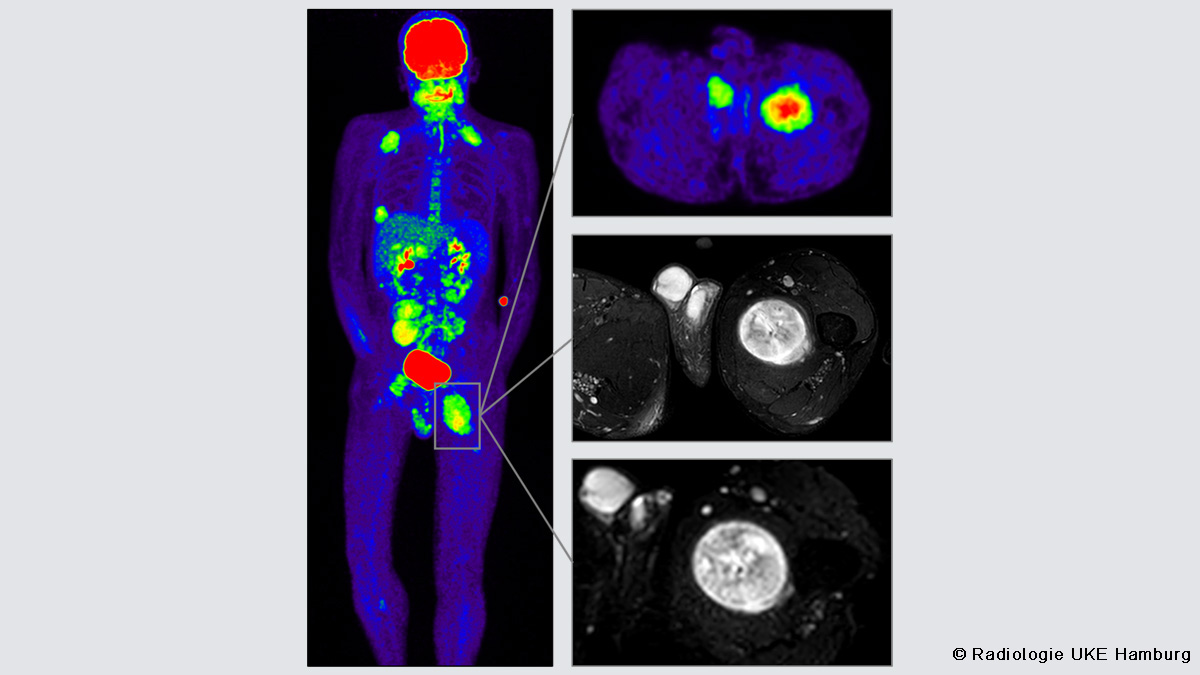 Teaserbild zum CME: Bildgebung der Neurofibromatose Typ-1 (NF1)