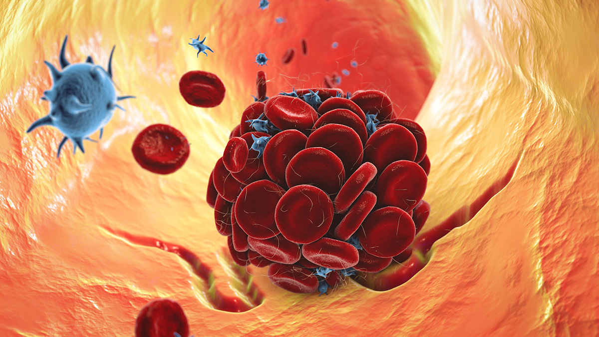 Teaserbild zum CME: Transplantationsassoziierte thrombotische Mikroangiopathie (TA-TMA)