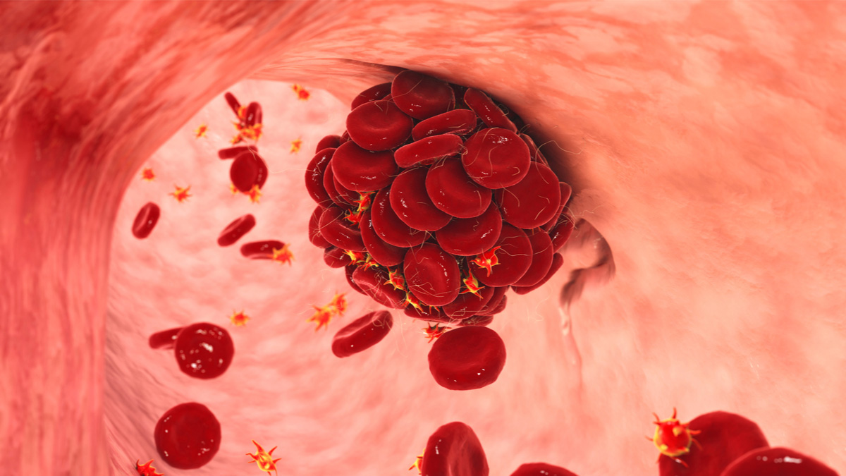 Logo der CME Fortbildung "Behandlung venöser Thromboembolien bei Erwachsenen und Betrachtung spezieller Risikopatienten"