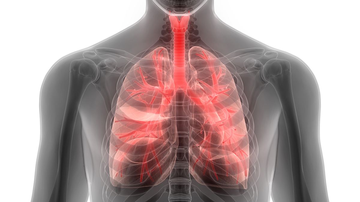 Teaserbild zum CME: Die Rolle der Osteoprotektion bei Patienten mit Lungenkarzinom