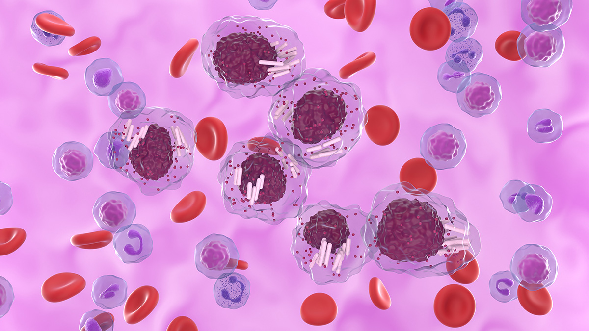 Teaserbild zum CME: CLL: Leitlinien-Update