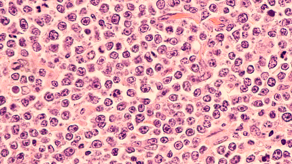 Logo der CME Fortbildung "Therapeutische Strategien beim diffusen großzelligen B-Zell-Lymphom (DLBCL)"
