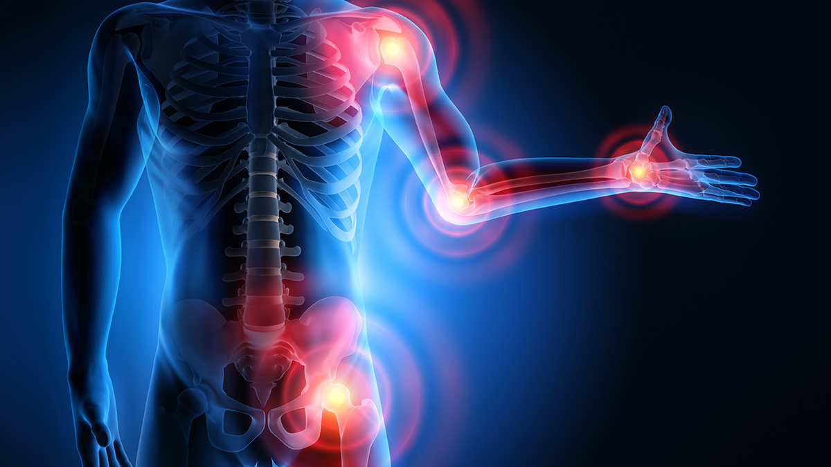 Teaserbild zum CME: Hypophosphatasie (HPP) als Differenzialdiagnose in der Rheumatologie