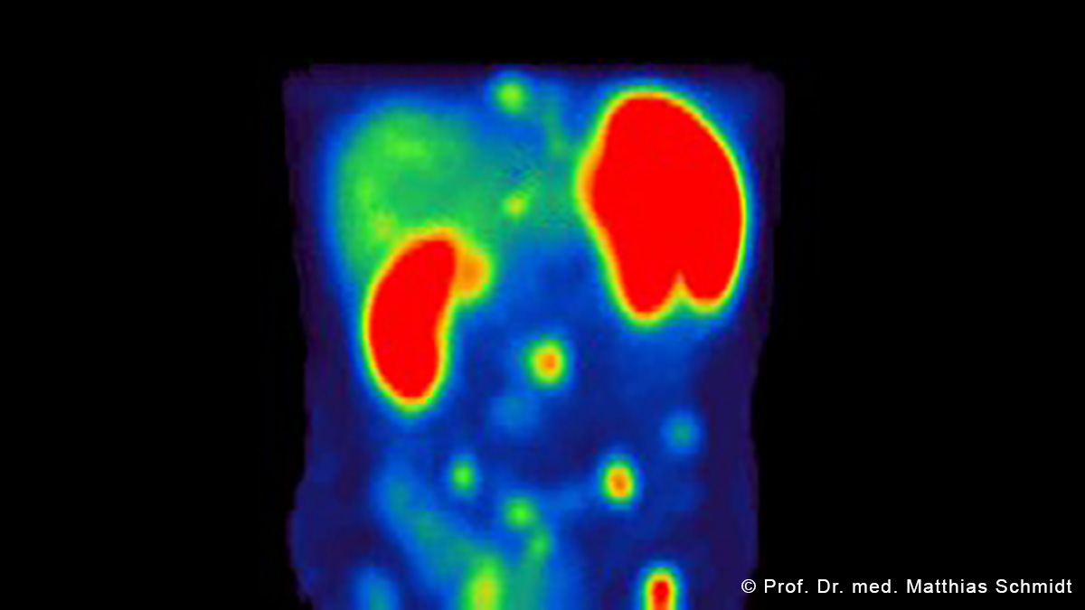 Teaserbild zum CME: Diagnose Neuroendokrine Tumoren - Fokus Nuklearmedizin