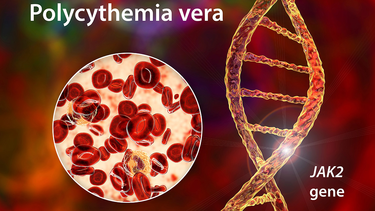 Logo der CME Fortbildung "Diagnose und Therapie der Polycythaemia vera"