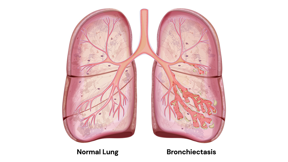Logo der CME Fortbildung "Bronchiektasen – Erkennung, Diagnostik und Therapie nach der neuen S2k-Leitlinie"