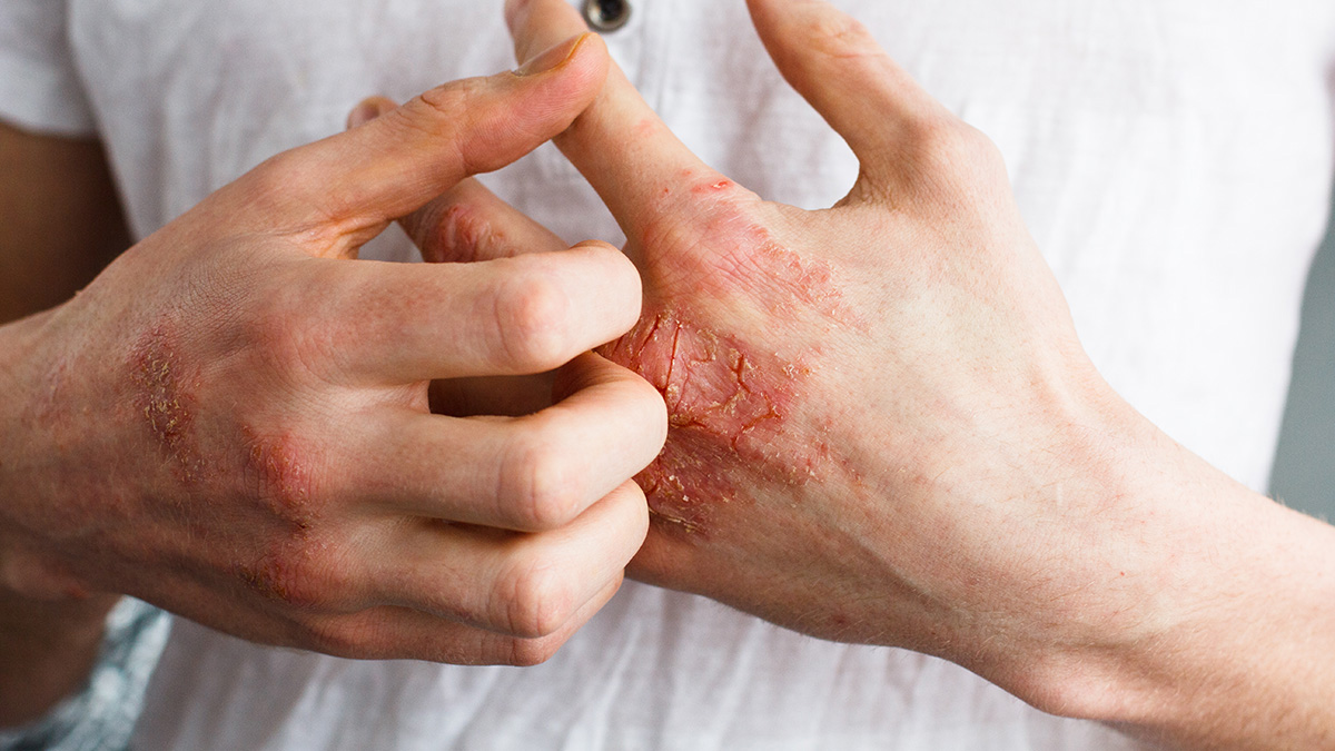Teaserbild zum CME: Atopische Dermatitis: Klinische Phänotypen und Behandlungsstrategien zum individuellen Management Teaserbild zum CME: Atopische Dermatitis: Klinische Phänotypen und Behandlungsstrategien zum individuellen Management