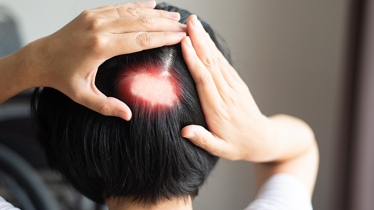 Logo der CME Fortbildung "Haarwuchsstörungen - Alopezie hat viele Auslöser"