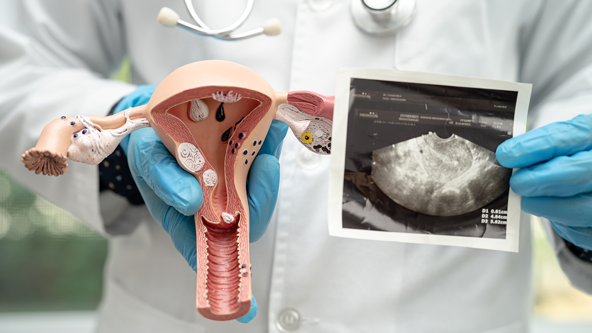 Teaserbild zum CME: Myome: Invasive und nicht-invasive Therapien und Fertilität Teaserbild zum CME: Myome: Invasive und nicht-invasive Therapien und Fertilität