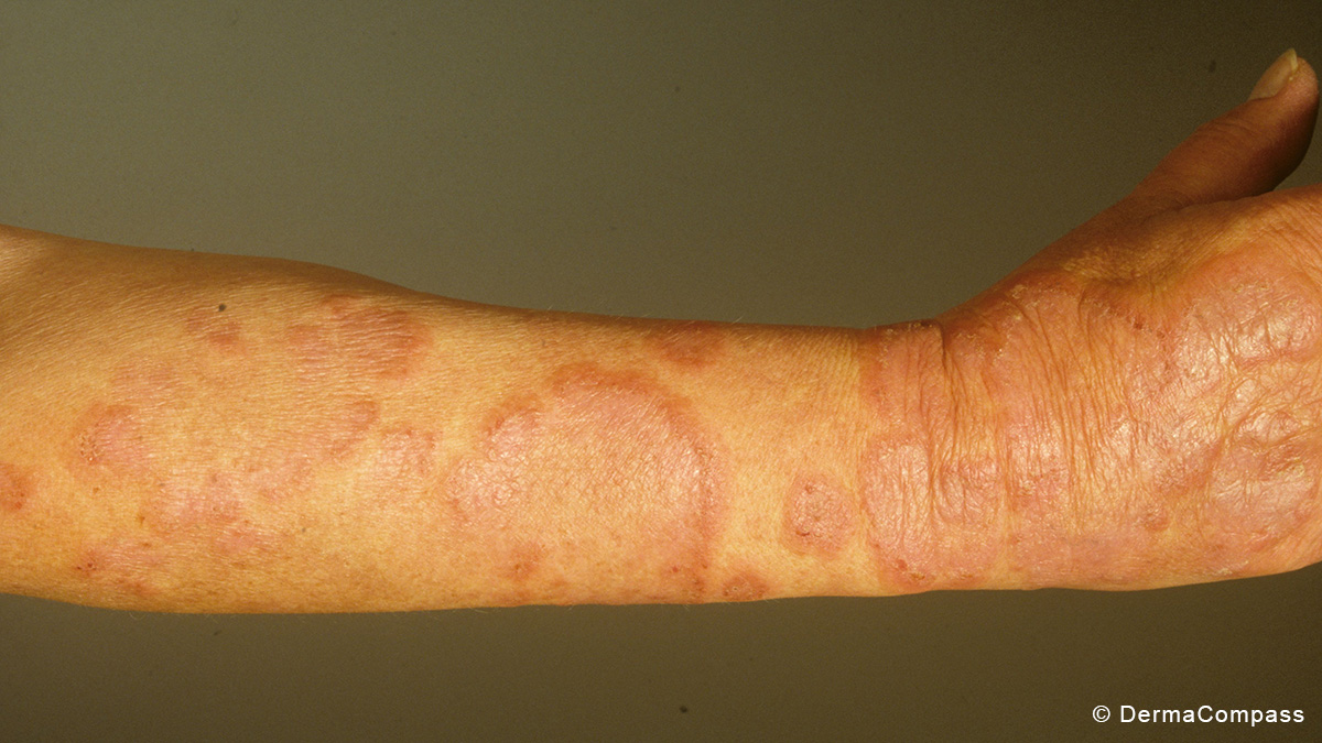 Teaserbild zum CME: Strahlentherapie bei kutanen Lymphomen: Empfehlungen der EORTC-Arbeitsgruppe
