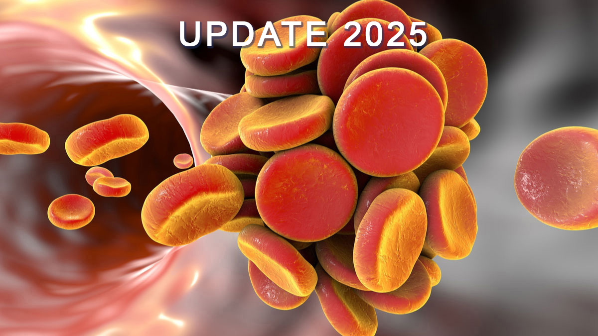 Teaserbild zum CME: Therapie und Rezidivprophylaxe tumorassoziierter venöser Thromboembolien bei Erwachsenen Teaserbild zum CME: Therapie und Rezidivprophylaxe tumorassoziierter venöser Thromboembolien bei Erwachsenen