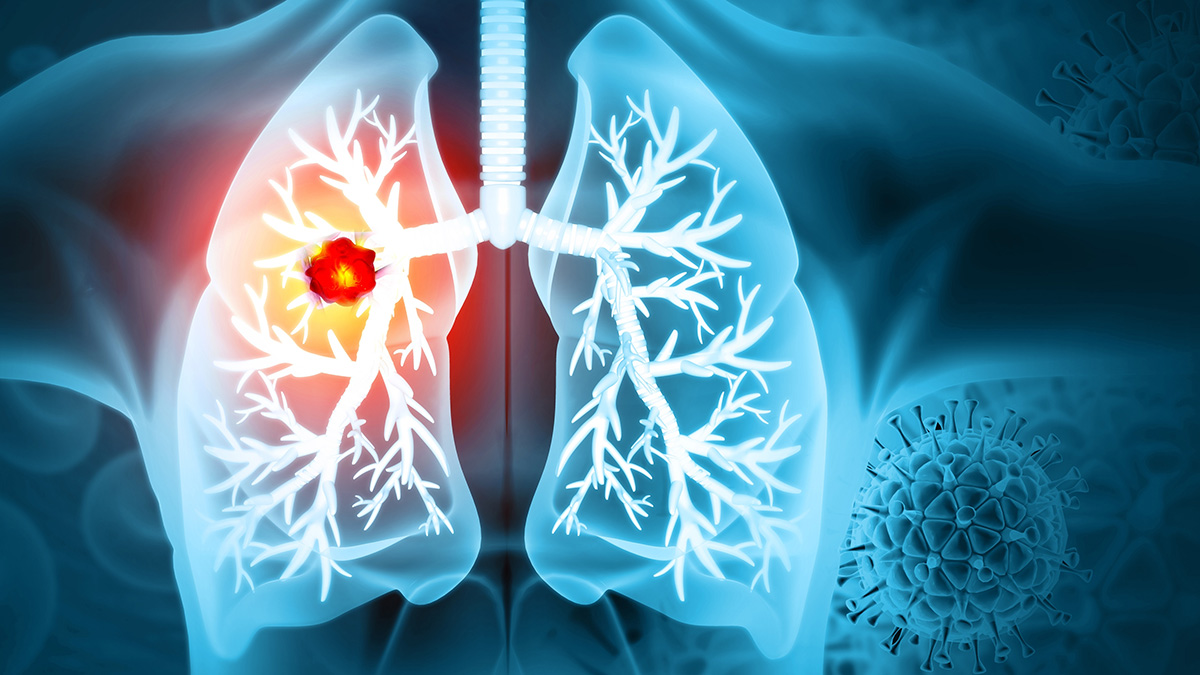 Logo der CME Fortbildung "NSCLC - Behandlung der frühen Stadien"