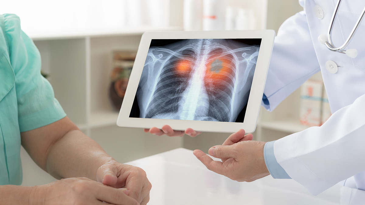Logo der CME Fortbildung "IO-Therapie beim metastasierten NSCLC - Entwicklungen der letzten 10 Jahre, was haben wir gelernt"