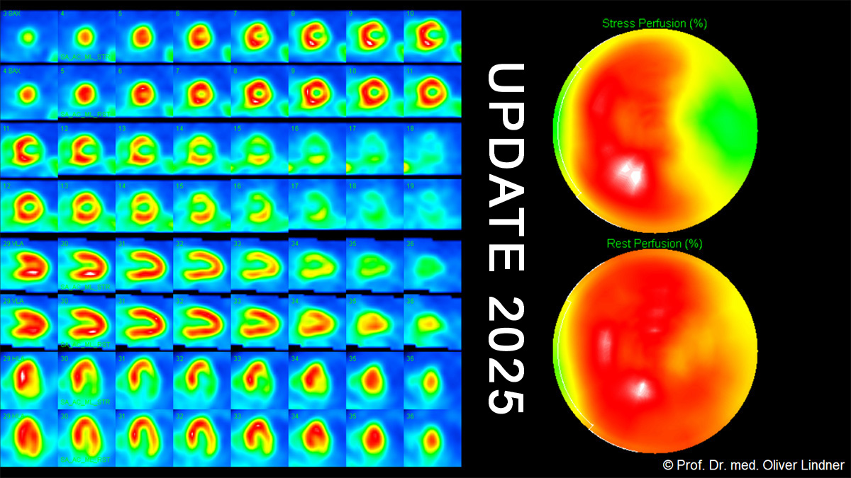 Teaserbild zum CME: Bildgebende Diagnostik der koronaren Herzkrankheit (KHK) - Stellenwert der Myokard-SPECT