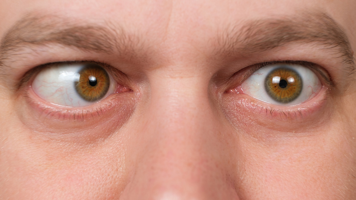 Teaserbild zum CME: Endokrine Orbitopathie (TED, thyroid eye disease) – Ein Überblick zu den Therapieoptionen