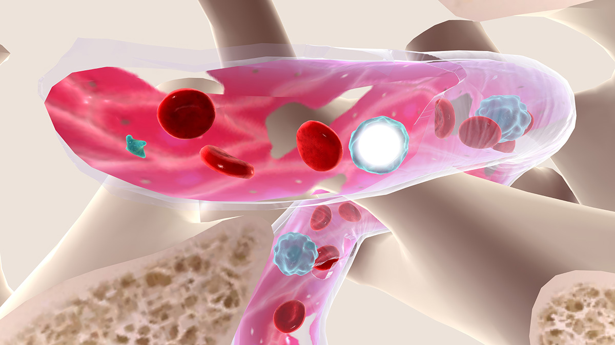 Teaserbild zum CME: Myelofibrose heute: Von der Diagnose zur Therapieentscheidung Teaserbild zum CME: Myelofibrose heute: Von der Diagnose zur Therapieentscheidung