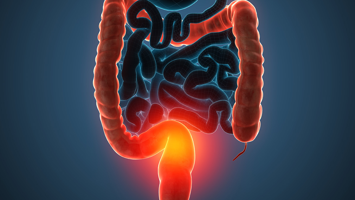 Teaserbild zum CME: Therapie bei leichter bis mittelschwerer Colitis ulcerosa